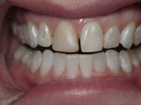 Veneers Case 4 - Before