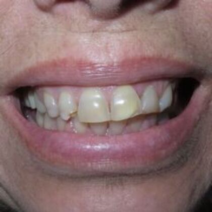 Veneers Case 5 - Before