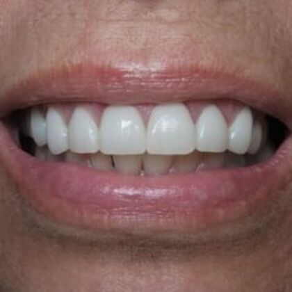 Veneers Case 5 - After