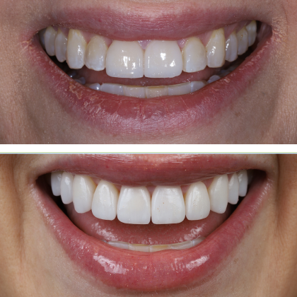 Minimal Prep Porcelain Veneers Cari - Before