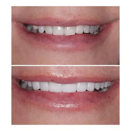 Smile Gallery  Case 8