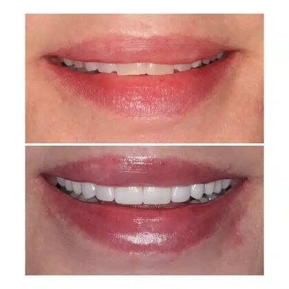 Smile Gallery  Case 9