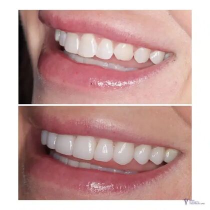 Smile Gallery  Case 10