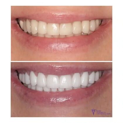 Smile Gallery  Case 11