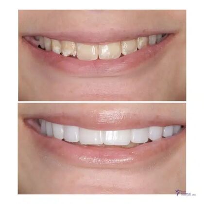 Smile Gallery  Case 12