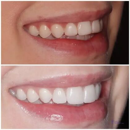 Smile Gallery : Case 13 - Before & After