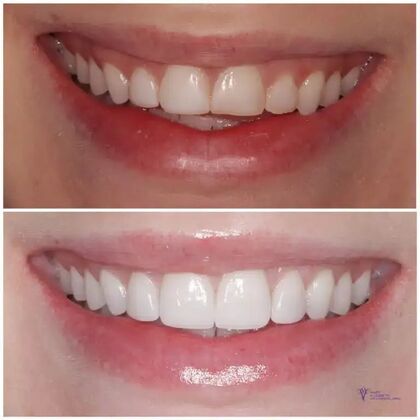 Smile Gallery : Case 13 - Before & After