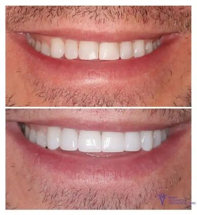 Smile Gallery  Case 14