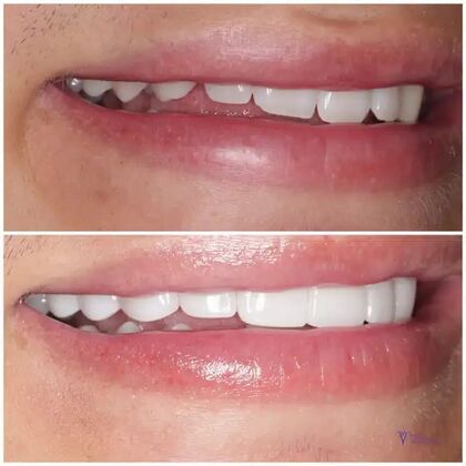 Smile Gallery  Case 15