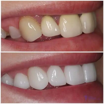 Smile Gallery  Case 16