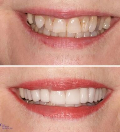 Smile Gallery  Case 17