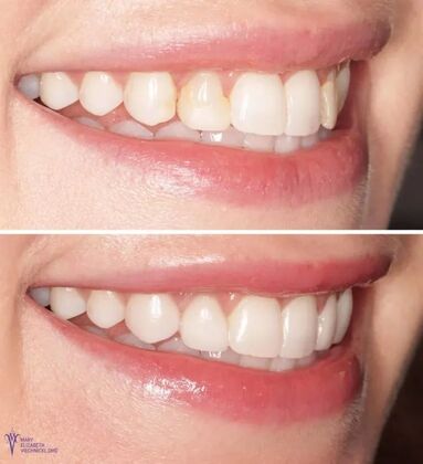 Smile Gallery  Case 18