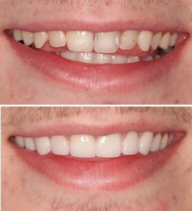 Smile Gallery  Case 20