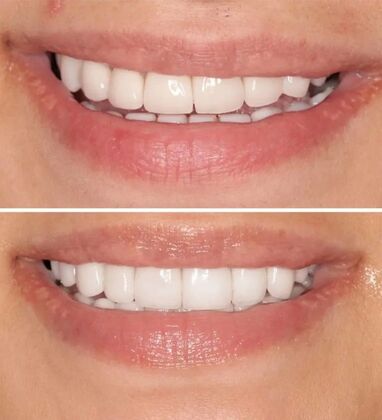 Smile Gallery  Case 21