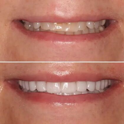 Smile Gallery  Case 22