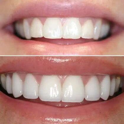 Smile Gallery  Case 23