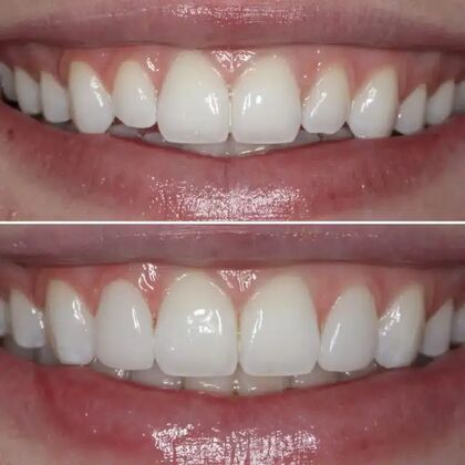 Smile Gallery  Case 24