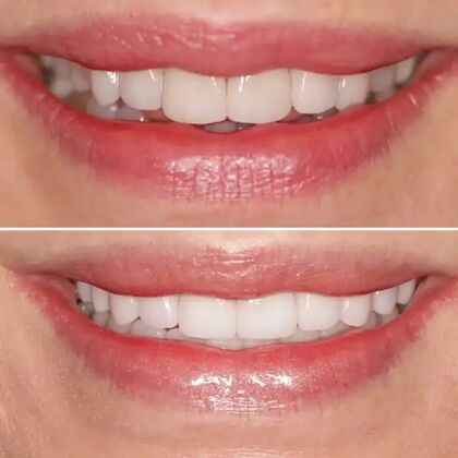 Smile Gallery  Case 25