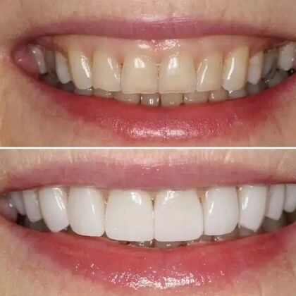 Smile Gallery  Case 26