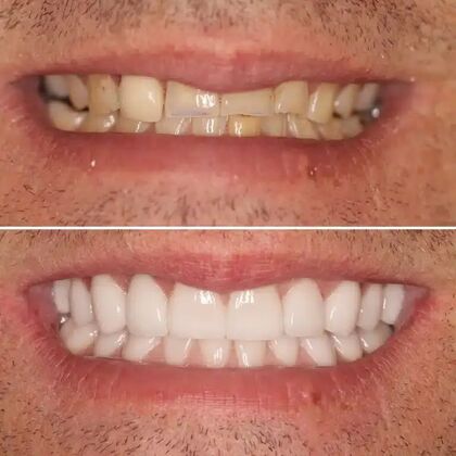 Smile Gallery  Case 28