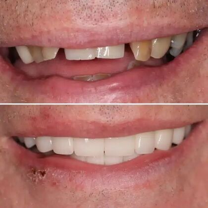 Smile Gallery  Case 30