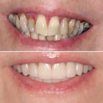 Smile Gallery  Case 31