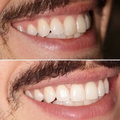 Smile Gallery  Case 32