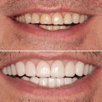 Smile Gallery  Case 33