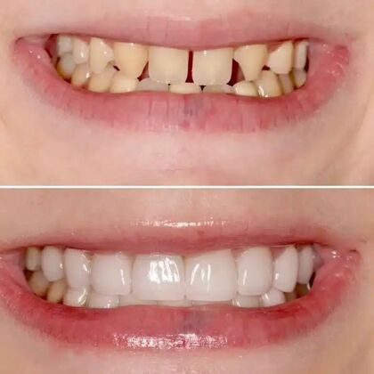 Smile Gallery  Case 34