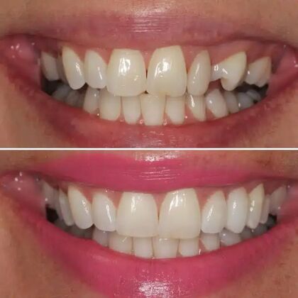 Smile Gallery  Case 35