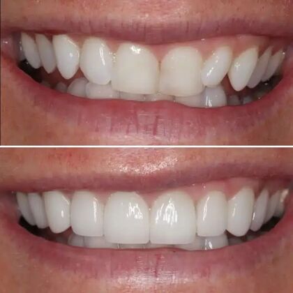 Smile Gallery  Case 38