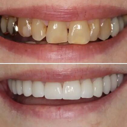 Smile Gallery  Case 39