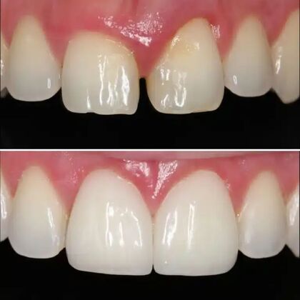 Smile Gallery  Case 40