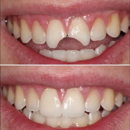 Smile Gallery  Case 41