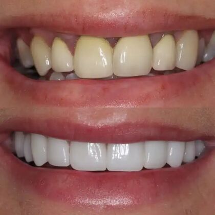 Smile Gallery  Case 42