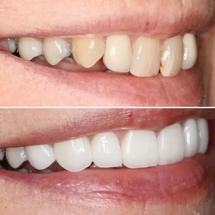 Smile Gallery  Case 43