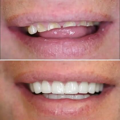 Smile Gallery  Case 45