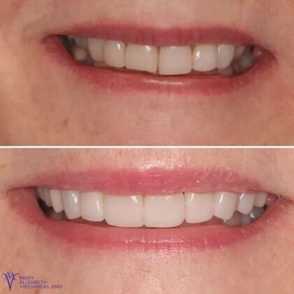 Smile Gallery  Case 46