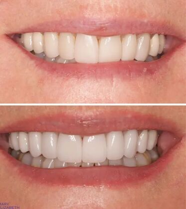 Smile Gallery  Case 47