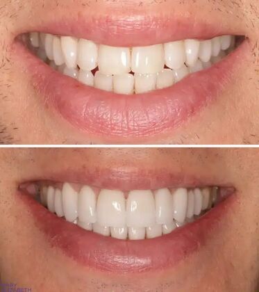 Smile Gallery  Case 48