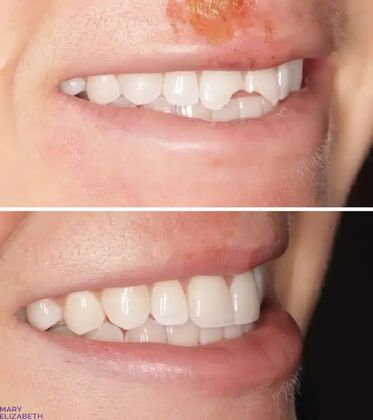 Smile Gallery  Case 49