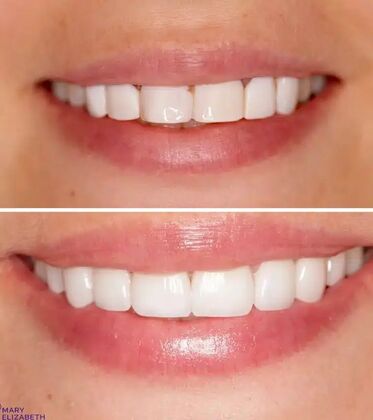 Smile Gallery  Case 50