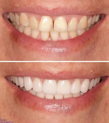 Smile Gallery  Case 51