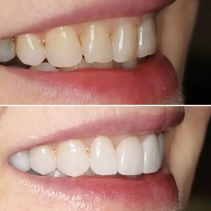 Smile Gallery  Case 52