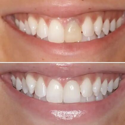 Smile Gallery  Case 54