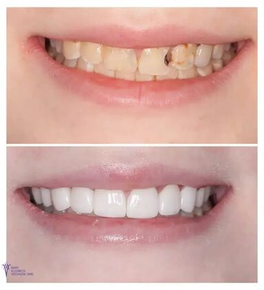 Smile Gallery  Case 55