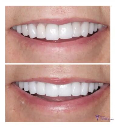 Smile Gallery  Case 56