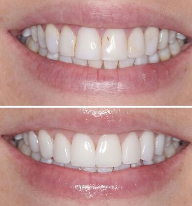 Smile Gallery  Case 58