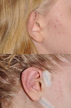 Otoplasty One day after otoplasty before and after!