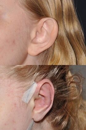 Otoplasty: One day after otoplasty before and after! - Before and 1 day after